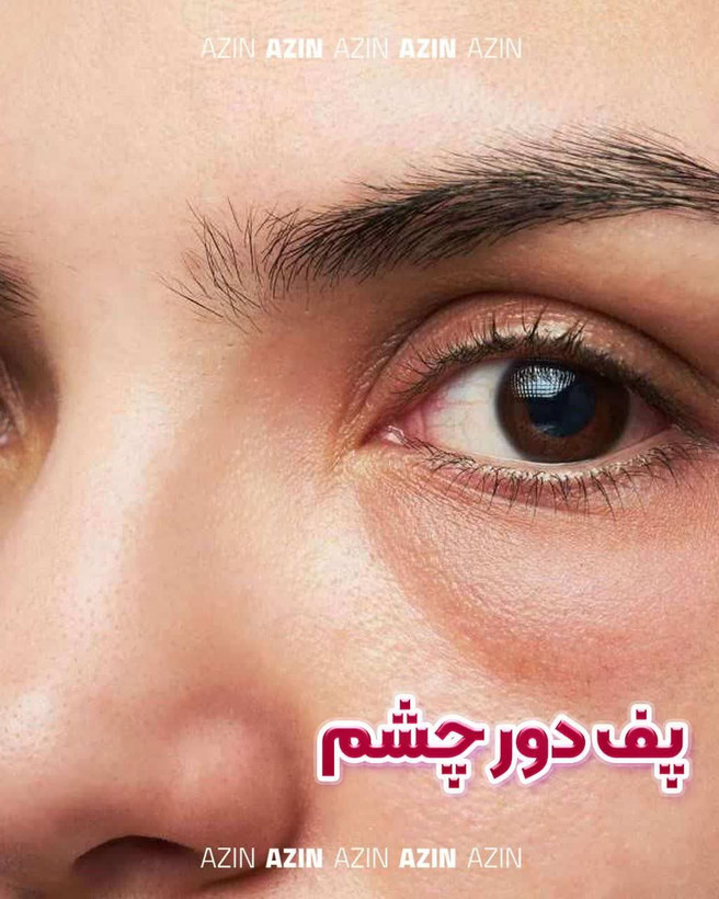 کرم رفع پف و میلیا دور چشم اذین