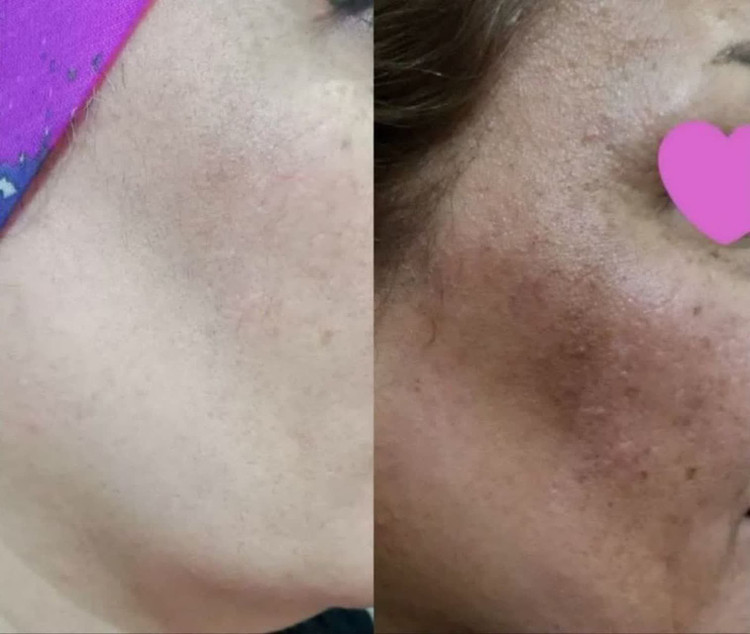 وای خدایا لک پوستشو ببین🙈 رضایت زیباجوی عزیز از 😍بیوممتیک ویتامین سی گاتیو😍 چقدررر خوب شده پوستش لک هاش کامل رفته این یعنی محصول درست دوره ی درست صبوری تا حصول نتیجه 😍✅