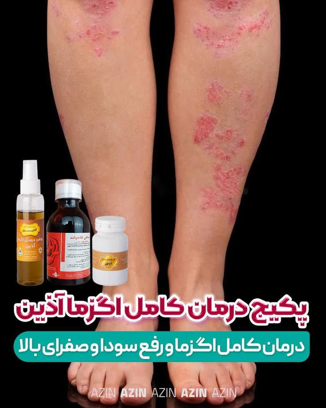 پک اگزما اذین