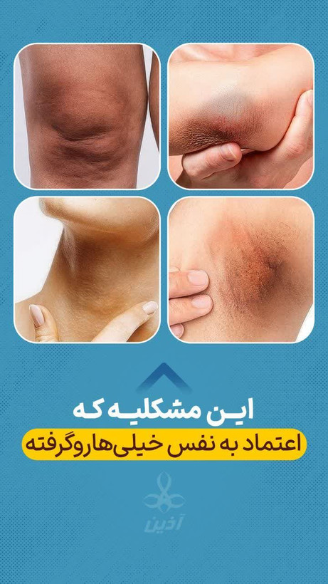 کرم گلامور فوق قوی اذین