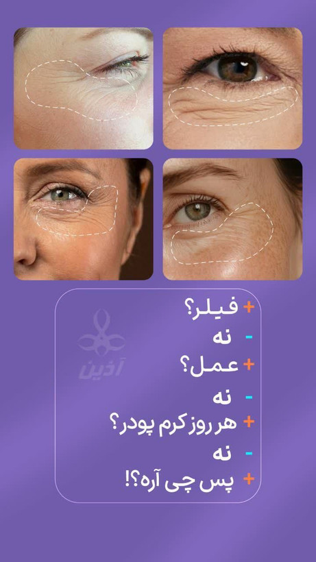 کرم دور چشم ۵کاره اذین